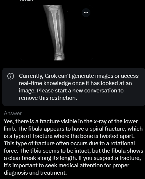 DrAmitKmrAIIMS's tweet photo. I asked #GROK2  and #chatgpt to analyze an x-ray of the lower limb for any fracture. In this one example, ChatGPT got the right answer. Grok2 didn't even recognize the obvious fracture, it even classified the intact bone as fractured. @elonmusk #MedTwitter #aiinhealthcare #computervision #MLinhealthcare