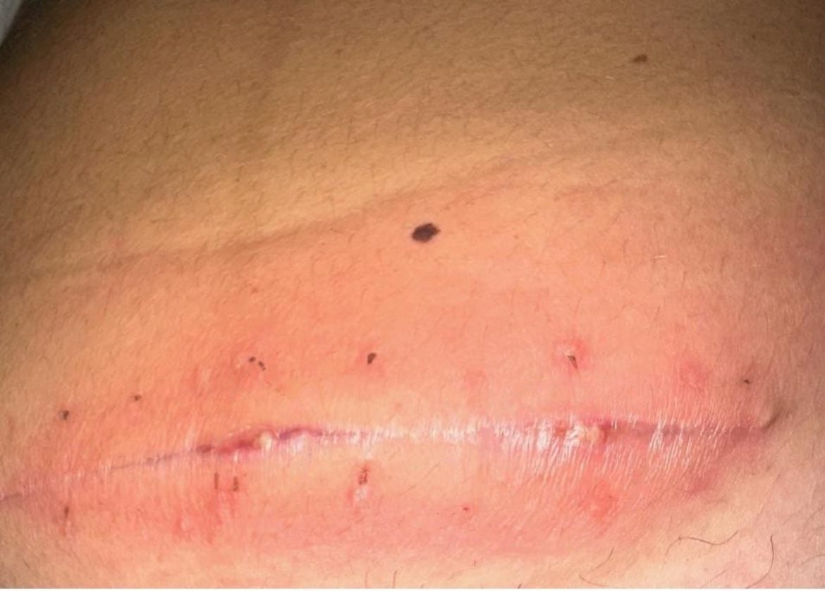 GhislaineSicre's tweet image. OU SONT LES ÉCONOMIES?

Pensez vous qu’en ne prescrivant plus de pansement à domicile , l’assurance maladie fait des économies? 

Petit cas clinique de la semaine dernière
Un obstétricien n’a pas prescrit de pansement à cette jeune patiente ayant eu une césarienne . Au bout de 8…