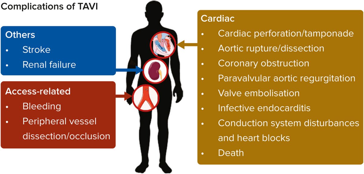 New #JACCAsia Position Statement: bit.ly/3Yu14Q6

The APSC, w/ experts across cardiology fields, developed a position statement on #TAVI use in AS mgmt. Using the GRADE system, they reviewed evidence, voted online, &amp; reached consensus. The resulting 28 statements guide