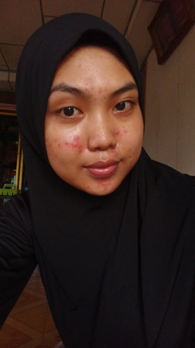 onlyhanaa_'s tweet photo. From this                              To this
maju kalian semua yang bilang jerawat ga bisa sembuh, kuncinya adalah balik ke BASIC SKINCARE (Fw, Mois, Ss + Double Cleansing)
sinii aku kasih tau beberapa produk yang aku pake untuk melawan jerawat yang ada di wajahkuu🙂‍↕️🙂‍↕️ https://t.co/CO8Ftk9iNq