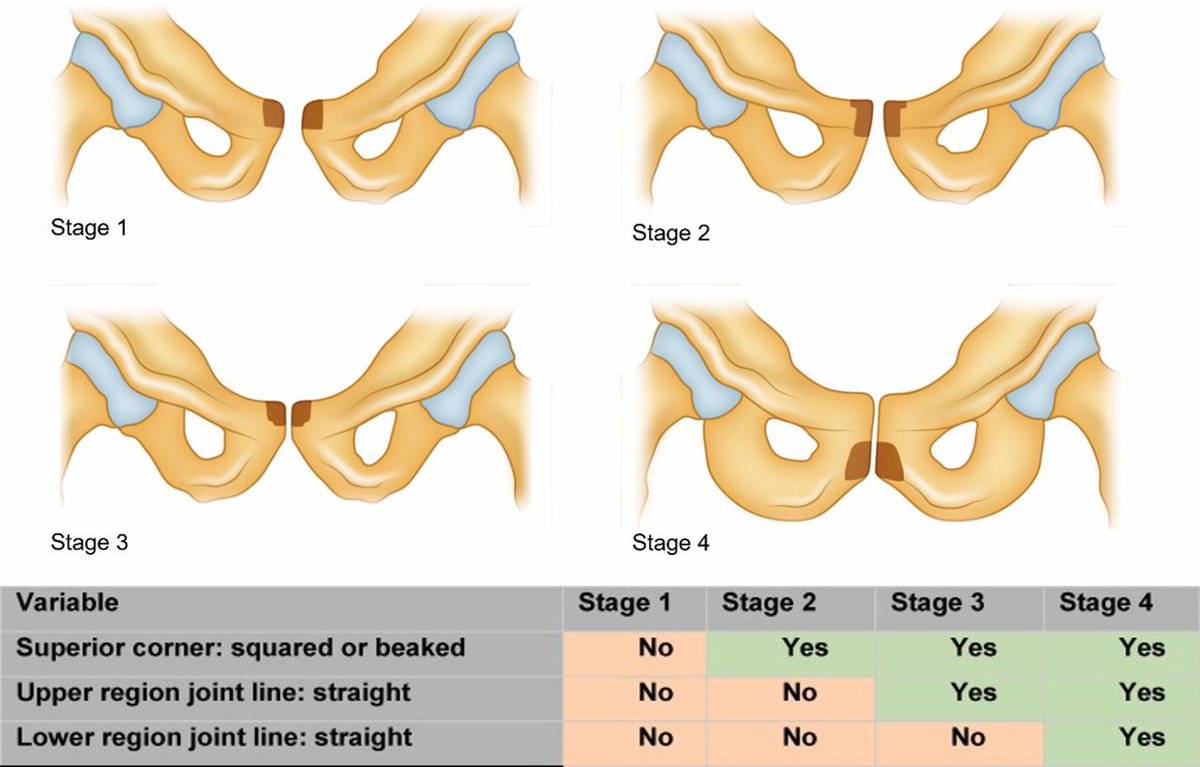 📣 #BestofBJSM for September❗️

What were our most popular posts of last month? 🔥 🔥

🥇 #ConsensusStatement - Multiligament knee injury - bit.ly/3AiYvbk

🥇 #ImagesinSEM - Pubic apophysitis - bit.ly/4fpp25B

🥇 #BJSMBlog - Greater trochanteric pain syndrome