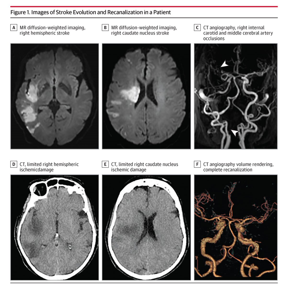 This narrative review gives an overview of recent large volume stroke trials in which mechanical thrombectomy was utilized. Conclusions and limitations of the studies, along with practical advice for clinicians, are provided. ja.ma/40tfe6n