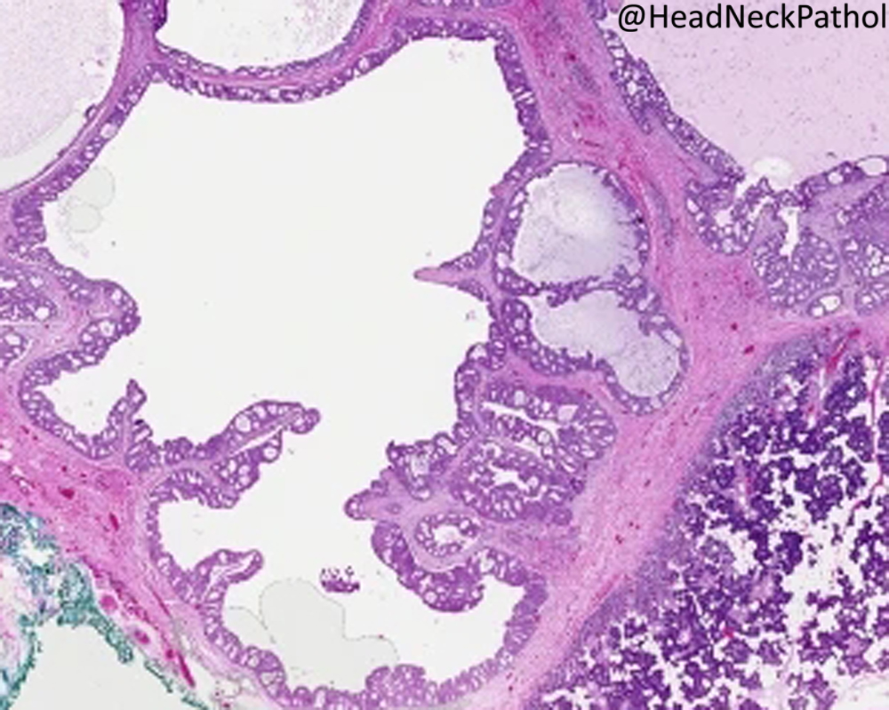 HeadandNeckPath's tweet photo. Pure Apocrine Intraductal Carcinoma of Salivary Glands: Reassessment of Molecular Underpinnings and Behavior
By Delfin, Doff, Gagan, Flack, Krane, Jo, Torell, Palsgrove &amp; Bishop
https://t.co/bOGP0eEXrY
#HeadNeckPathol #HNPJ #HeadandNeckPath #Pathology #ENTPath #PathologyTweet https://t.co/Y6qXB0Y6nX
