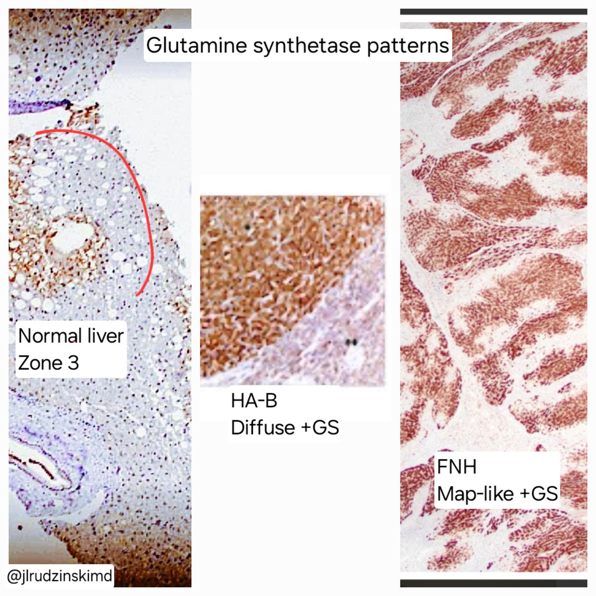 Jaclyn Rudzinski, MD (@jlrudzinskimd) on Twitter photo Glutamine Synthetase in liver, L to R:
Normal Zone 3. Hepatocellular adenoma, some subtypes. Beta cat. HA-B, +GS. Tried to keep simple but found HA-I overlaps w/ FNH. Link to ref 👇 Focal nodular hyperplasia. Map-like GS, central scar, clin OCP.
Photos HA-B, FNH <a href="/Pathoutlines/">PathologyOutlines.com</a> Glutamine Synthetase in liver, L to R:
Normal Zone 3. Hepatocellular adenoma, some subtypes. Beta cat. HA-B, +GS. Tried to keep simple but found HA-I overlaps w/ FNH. Link to ref 👇 Focal nodular hyperplasia. Map-like GS, central scar, clin OCP.
Photos HA-B, FNH <a href="/Pathoutlines/">PathologyOutlines.com</a>
