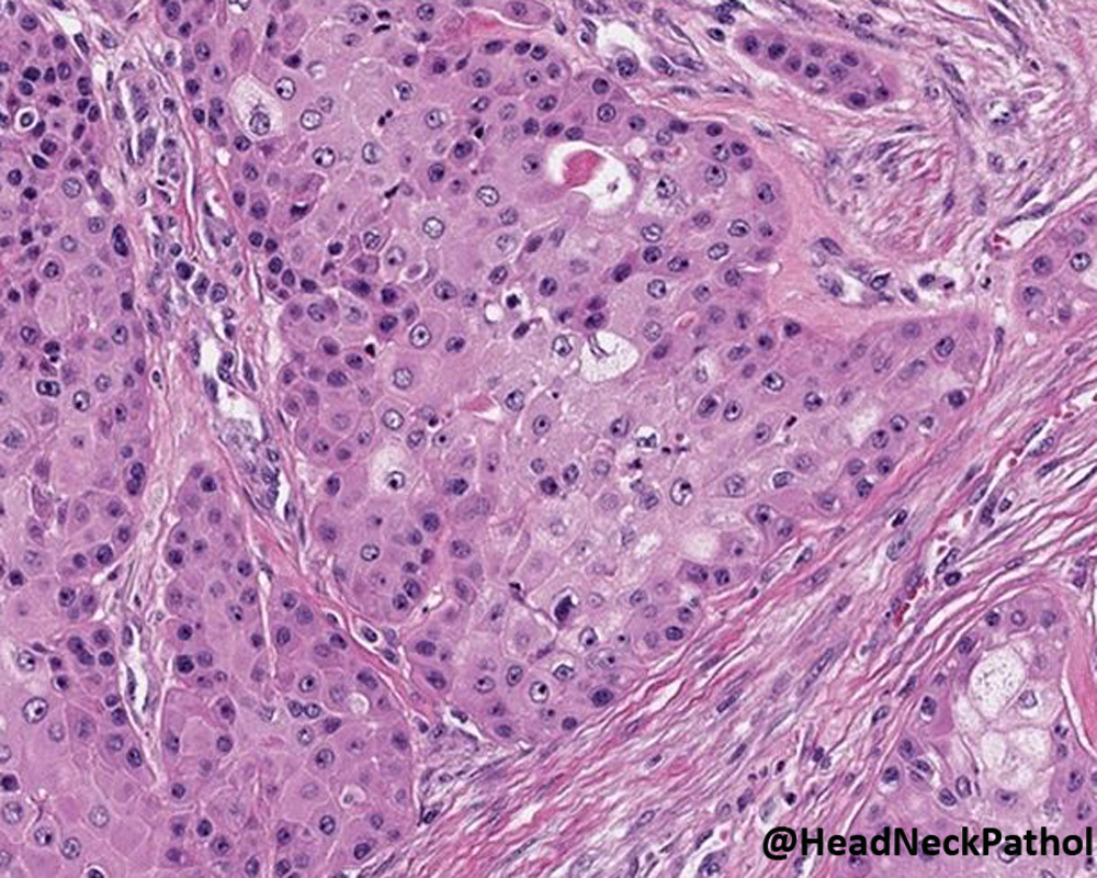 HeadandNeckPath's tweet photo. Oncocytoid Salivary Tumors: Differential Diagnosis and Utility of Newly Described Immunohistochemistry
By Nora Katabi
https://t.co/YB4JvfyOW5
#HeadNeckPathol #HNPJ #HeadandNeckPath #Pathology #ENTPath #PathologyTweet https://t.co/DtOmcKFBxR