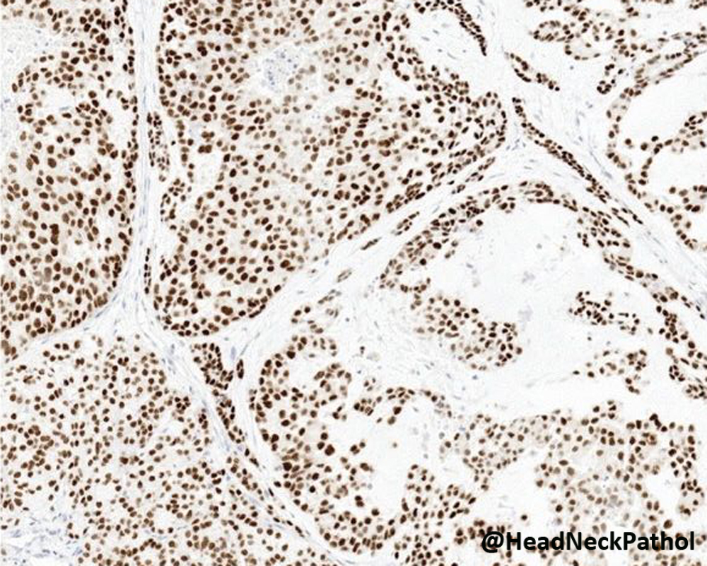 HeadandNeckPath's tweet photo. Oncocytoid Salivary Tumors: Differential Diagnosis and Utility of Newly Described Immunohistochemistry
By Nora Katabi
https://t.co/YB4JvfyOW5
#HeadNeckPathol #HNPJ #HeadandNeckPath #Pathology #ENTPath #PathologyTweet https://t.co/DtOmcKFBxR