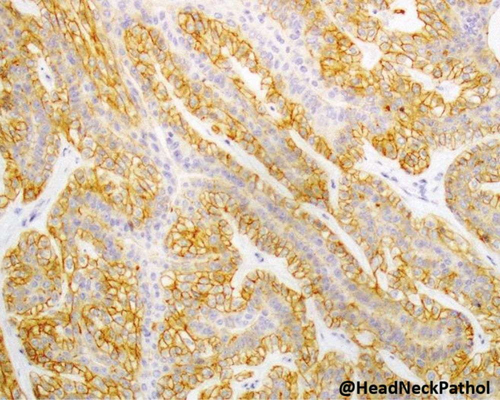 HeadandNeckPath's tweet photo. Oncocytoid Salivary Tumors: Differential Diagnosis and Utility of Newly Described Immunohistochemistry
By Nora Katabi
https://t.co/YB4JvfyOW5
#HeadNeckPathol #HNPJ #HeadandNeckPath #Pathology #ENTPath #PathologyTweet https://t.co/DtOmcKFBxR