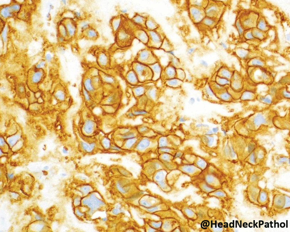 HeadandNeckPath's tweet photo. Oncocytoid Salivary Tumors: Differential Diagnosis and Utility of Newly Described Immunohistochemistry
By Nora Katabi
https://t.co/YB4JvfyOW5
#HeadNeckPathol #HNPJ #HeadandNeckPath #Pathology #ENTPath #PathologyTweet https://t.co/DtOmcKFBxR