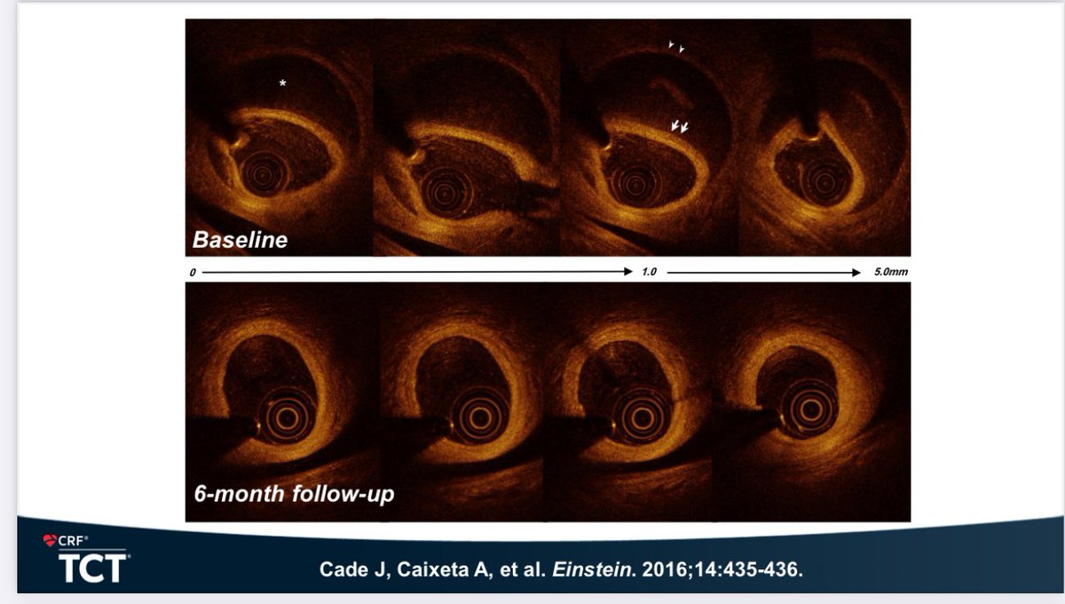 Adriano Caixeta MD, PhD, DSc (@adrianocaixeta) on Twitter photo Thank you #tct2024 <a href="/crfheart/">Cardiovascular Research Foundation</a> for the opportunity to present our #SCALIBUR Registry on spontaneous coronary artery dissection in the Brazilian population. Thank you to all co-authors. #SCAD <a href="/SCADalliance/">SCAD Alliance</a> <a href="/SCADResearch/">SCAD Research Inc.</a> <a href="/beatscaduk/">Beat SCAD UK</a> <a href="/JamilCade/">Jamil Cade, MD, PhD</a> <a href="/carlos__campos/">Carlos M. Campos, MD, PhD</a> #women <a href="/PaulaSantiagoMD/">paula santiago</a> Thank you #tct2024 <a href="/crfheart/">Cardiovascular Research Foundation</a> for the opportunity to present our #SCALIBUR Registry on spontaneous coronary artery dissection in the Brazilian population. Thank you to all co-authors. #SCAD <a href="/SCADalliance/">SCAD Alliance</a> <a href="/SCADResearch/">SCAD Research Inc.</a> <a href="/beatscaduk/">Beat SCAD UK</a> <a href="/JamilCade/">Jamil Cade, MD, PhD</a> <a href="/carlos__campos/">Carlos M. Campos, MD, PhD</a> #women <a href="/PaulaSantiagoMD/">paula santiago</a>