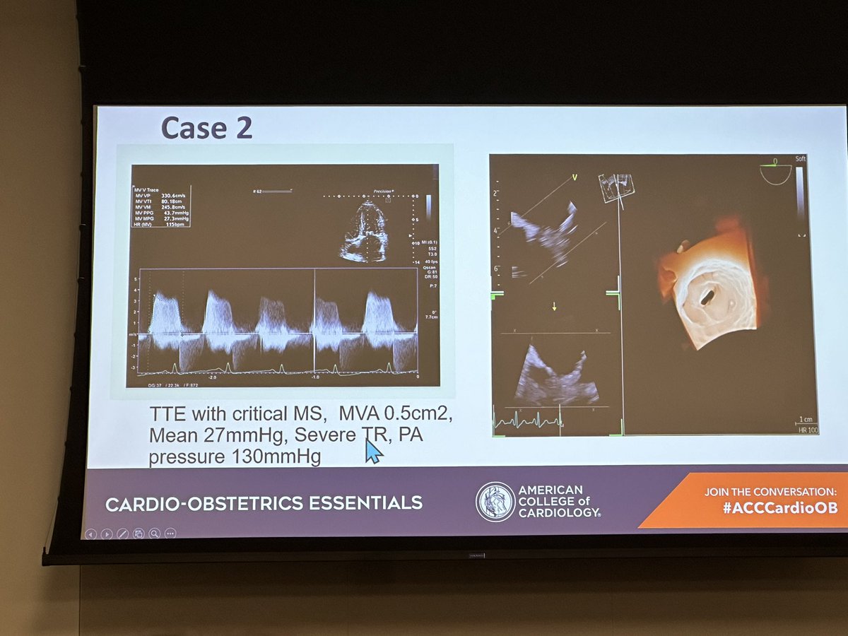AWCaiMD's tweet photo. Global perspectives on maternal RHD: MV gradients ~30, AV as high as 150! Amazing what the 🫀 can tolerate. 1’ prevention = vaccine &amp; reducing poverty; 2’ prevention with PCN G to reduce severity &amp; multi-valve involvement 
@SabhaBhatti #cardioobstetrics https://t.co/ftbODfcOt6