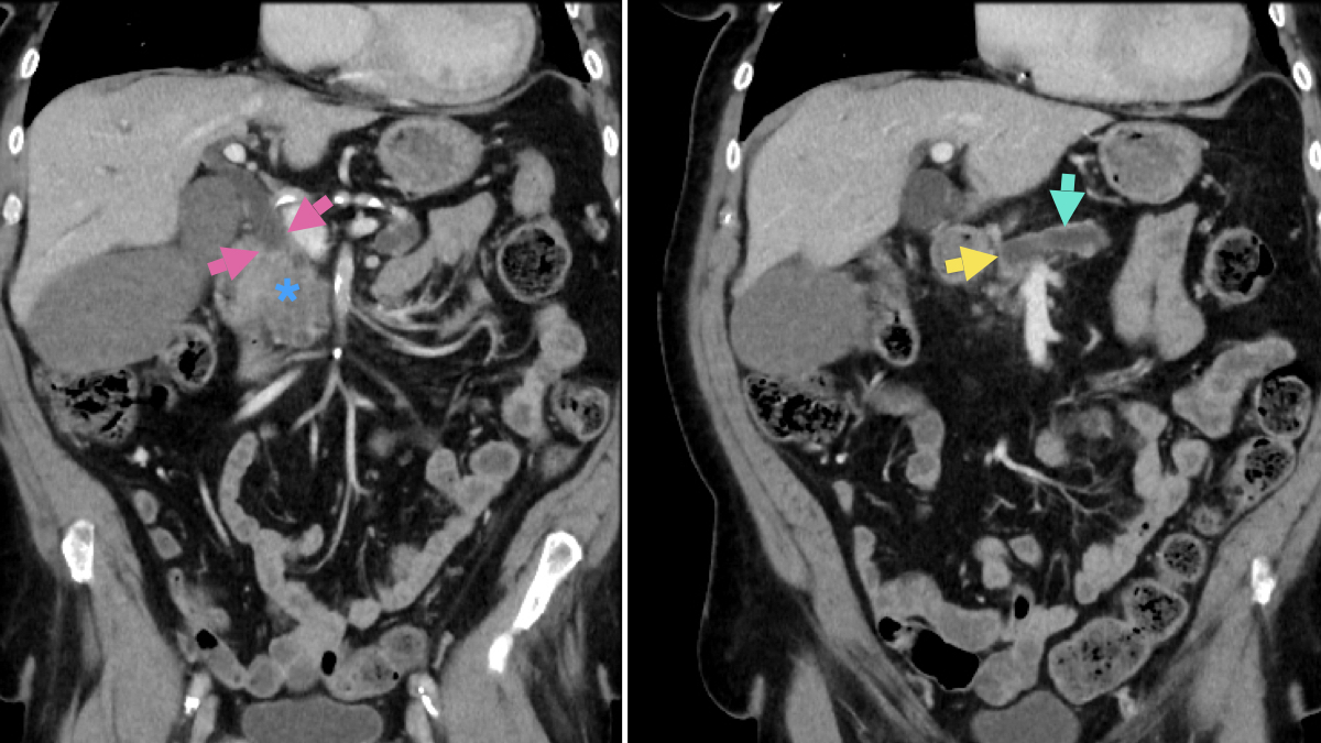 New Radiopaedia course released! Learn abdominal CT with @MP_Hartung. 2.5 hours of video lessons and well over 100 scrollable cases. Just $24 for 12 months access or free for All-Access Pass holders and in 125 LMIC. 

radiopaedia.org/courses/abdomi…

What your diagnosis for this one?