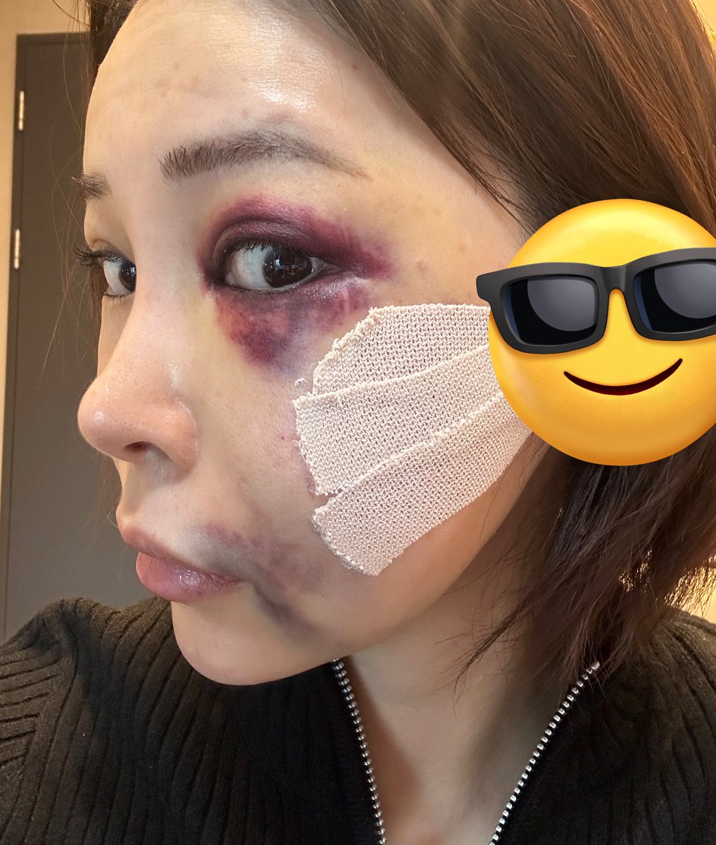 kaizo_TYPE1's tweet photo. ◼︎左頬骨削り　ＤＴ3日目
抗生剤と痛み止め点滴、アザ腫れのケア（ライトとか）、レントゲン撮って診察してついでに肩ボト顔ボトして終わり！

アザだけがアレだけど心配しても消えないし、鼻も腫れてる気が🥲

JUNOヘアーでシャンプーしてもらって半眼ゾンビ隠し前髪にセットしてもらいお散歩したで https://t.co/SB3NYxYBnd