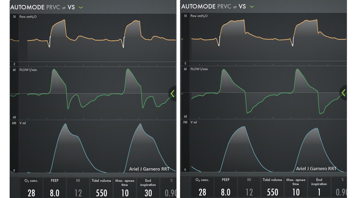 Ariel J Garnero (@arielg_rrt) on Twitter photo What bad interctaion is this? Was it improved? Why? TAG? <a href="/emireles_c/">Eduardo Mireles-Cabodevila</a> <a href="/CCF_PCCM/">CCF Pulmonary and Critical Care Fellows</a> <a href="/DocMusician/">Doc Musician</a> <a href="/IM_Crit_/">IMCrit</a> <a href="/critconcepts/">Critical Concepts</a> <a href="/OfVentilation/">Society of Mechanical Ventilation</a> <a href="/ATC_Ventilator/">Ben Fabry</a> <a href="/SaudiRTs/">Saudi Respiratory</a> <a href="/Vent_Busters/">VentBusters</a> <a href="/Srivatsa34/">SrivatsaNagachandan</a> <a href="/HibaVentila/">HIBA Ventila</a> <a href="/DrMiguelIbarra1/">Dr. Miguel Ibarra-Estrada</a> <a href="/RespiratorySCCM/">SCCM Respiratory Care Section</a> What bad interctaion is this? Was it improved? Why? TAG? <a href="/emireles_c/">Eduardo Mireles-Cabodevila</a> <a href="/CCF_PCCM/">CCF Pulmonary and Critical Care Fellows</a> <a href="/DocMusician/">Doc Musician</a> <a href="/IM_Crit_/">IMCrit</a> <a href="/critconcepts/">Critical Concepts</a> <a href="/OfVentilation/">Society of Mechanical Ventilation</a> <a href="/ATC_Ventilator/">Ben Fabry</a> <a href="/SaudiRTs/">Saudi Respiratory</a> <a href="/Vent_Busters/">VentBusters</a> <a href="/Srivatsa34/">SrivatsaNagachandan</a> <a href="/HibaVentila/">HIBA Ventila</a> <a href="/DrMiguelIbarra1/">Dr. Miguel Ibarra-Estrada</a> <a href="/RespiratorySCCM/">SCCM Respiratory Care Section</a>