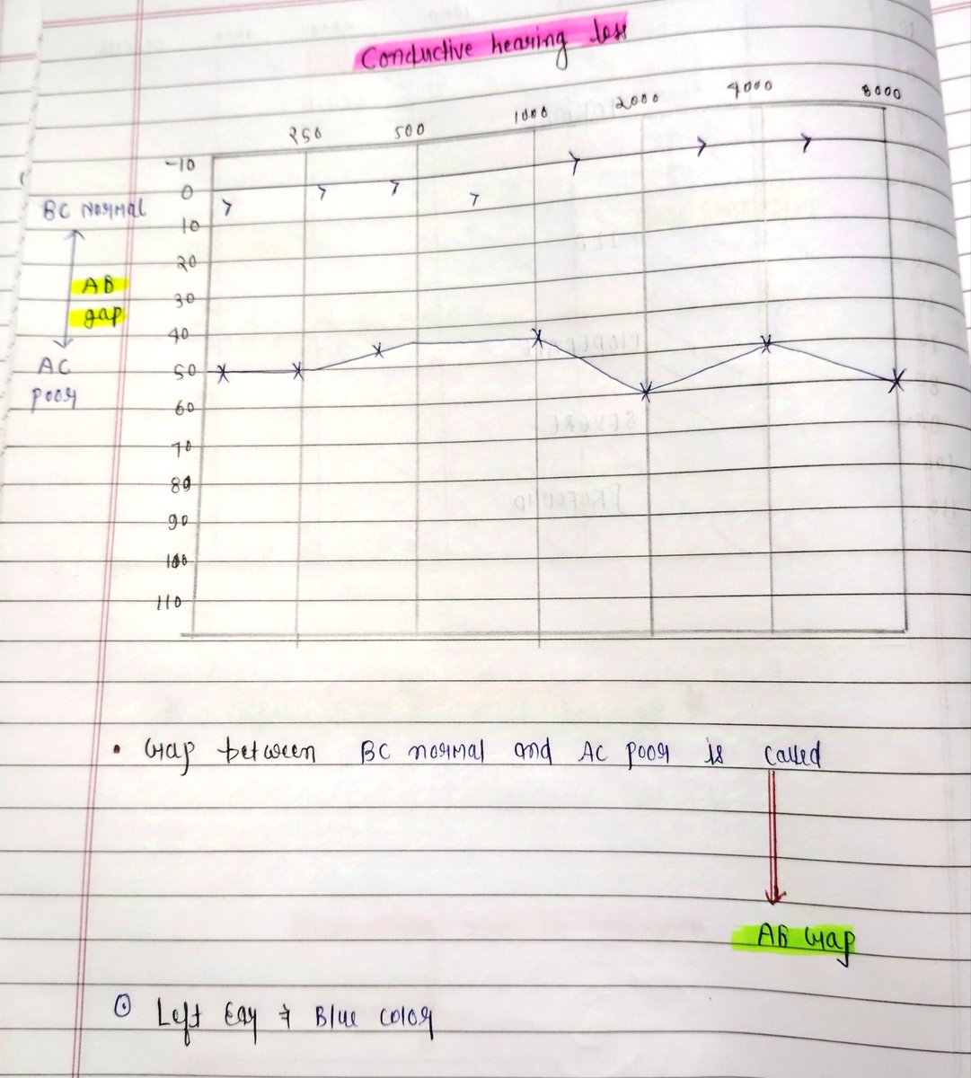 notes_146's tweet photo. Conductive hearing loss graph #mbbs #medico #pg #ug https://t.co/1fASB85BGs