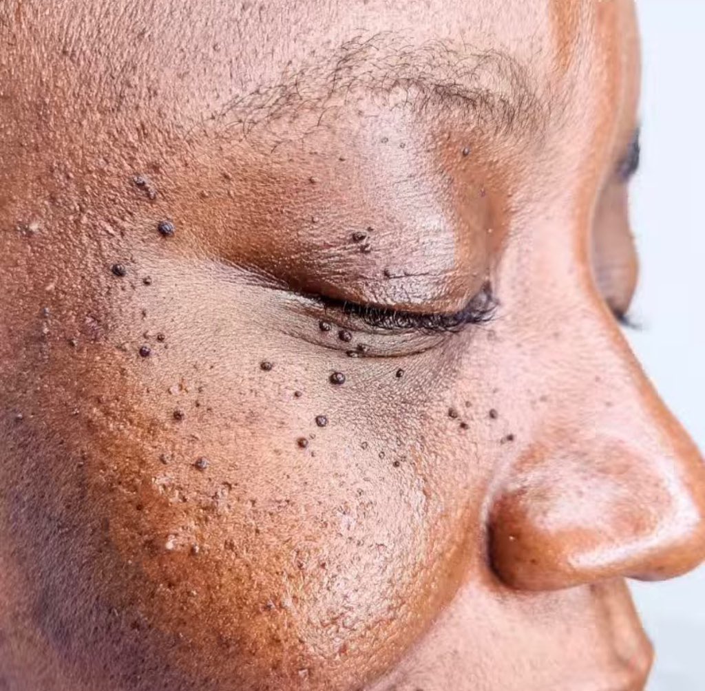 VerbenaWellness's tweet photo. Let's start the week with this Skin tag removal transformation!😍

✅No blistering
✅No scarring
✅No discoloration

#Verbenawellnessclinic #skintagremoval #skincareatitsbest #skintags https://t.co/Kihrsb85WR