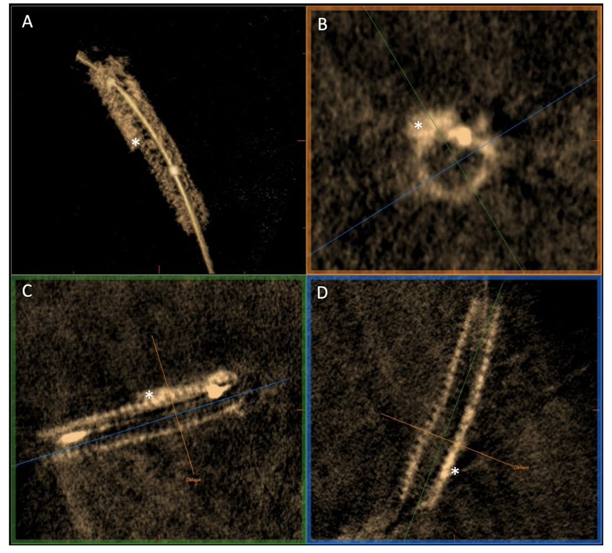 Salvatore Brugaletta (@sbrugaletta) on Twitter photo 3Dstent: good agreement in assessing stent area vs. OCT and a possible tool for evaluating calcium distribution for plaque preparation. <a href="/EuroInterventio/">EuroIntervention</a> <a href="/CircIntv/">CircInterventions</a> <a href="/secardiologia/">Soc Esp Cardiología</a> <a href="/shci_sec/">ACI-SEC: Hemodinamica</a> <a href="/PCRonline/">PCRonline 🫀</a> <a href="/ColletCarlos/">Carlos Collet MD PhD</a> <a href="/hect2701/">Prof. Hector M. Garcia-Garcia</a> <a href="/crfheart/">Cardiovascular Research Foundation</a> <a href="/OPCILive/">OPCI</a> <a href="/ziadalinyc/">Ziad Ali</a> link.springer.com/article/10.100… 3Dstent: good agreement in assessing stent area vs. OCT and a possible tool for evaluating calcium distribution for plaque preparation. <a href="/EuroInterventio/">EuroIntervention</a> <a href="/CircIntv/">CircInterventions</a> <a href="/secardiologia/">Soc Esp Cardiología</a> <a href="/shci_sec/">ACI-SEC: Hemodinamica</a> <a href="/PCRonline/">PCRonline 🫀</a> <a href="/ColletCarlos/">Carlos Collet MD PhD</a> <a href="/hect2701/">Prof. Hector M. Garcia-Garcia</a> <a href="/crfheart/">Cardiovascular Research Foundation</a> <a href="/OPCILive/">OPCI</a> <a href="/ziadalinyc/">Ziad Ali</a> link.springer.com/article/10.100…