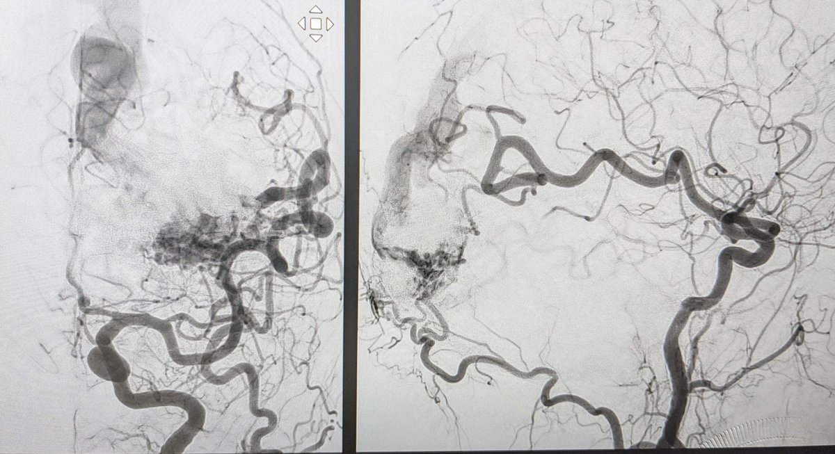 50, acúfenos, MAV occipital SM3, SMs 7. Aportes ACP, ACM, AMM, AMP, AO, drenaje ppal SSS. Optamos tratamiento combinado embo por Neurorrx int y a las 24h cirugía #Neurocirugía #HUMS