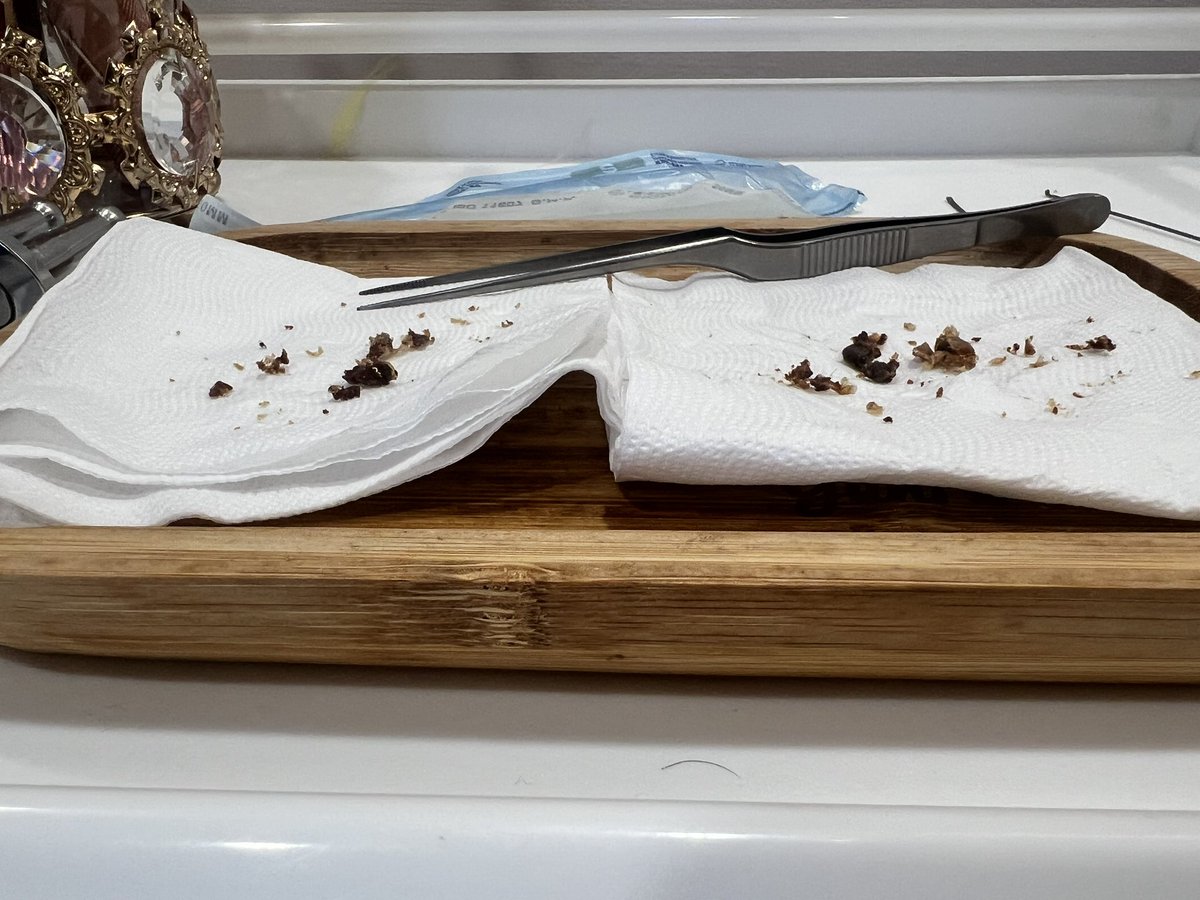 遠遠拍沒有近拍怕嚇到你們
客人三年沒清耳朵了
能想像耳道這麼小
塞這麽多耳屎嗎
有的人清出來很精彩
還好我的器材都用醫療級滅菌你們敢用上一個人用過的噴一噴酒精而已的器材嗎？

工作專業IG：yunistudio.tw
個人IG：yuni.8686

安心交給我💪🏻

#除毛師 #採耳師