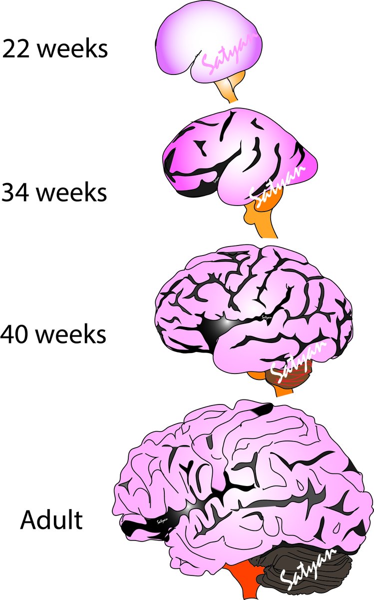 Satyan (@neosatyan) on Twitter photo This week's #Neographic - maturation of brain with age; Often illustrations show a brain with lots of gyri and sulci even for preterm; Here is #brain at extreme prematurity, moderate preterm, term and adult <a href="/AAPneonatal/">AAP Neonatal</a> <a href="/AmerAcadPeds/">American Academy of Pediatrics</a> <a href="/PiaWintermark/">NeoBrainLab</a> <a href="/HopeforHIE/">Hope for HIE ☀️</a> <a href="/AANeuro/">AAN</a> @UCDavis This week's #Neographic - maturation of brain with age; Often illustrations show a brain with lots of gyri and sulci even for preterm; Here is #brain at extreme prematurity, moderate preterm, term and adult <a href="/AAPneonatal/">AAP Neonatal</a> <a href="/AmerAcadPeds/">American Academy of Pediatrics</a> <a href="/PiaWintermark/">NeoBrainLab</a> <a href="/HopeforHIE/">Hope for HIE ☀️</a> <a href="/AANeuro/">AAN</a> @UCDavis