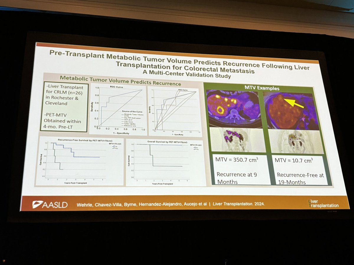 Smitha Krishnamurthi (@smitha42) on Twitter photo 🤩Super-informative talk by <a href="/FAucejo/">Federico Aucejo</a> re: #LiverTransplant <a href="/ClevelandClinic/">Cleveland Clinic</a> <a href="/CleveClinicFL/">Cleveland Clinic Florida</a> Cancer Conference.
👉1st liver TXP for met CRC at Cleveland Clinic was 2017.
👉Our approach adds locoregional Rx after systemic Rx prior to TXP.
👉Minimal PET activity pre TXP correlates 🤩Super-informative talk by <a href="/FAucejo/">Federico Aucejo</a> re: #LiverTransplant <a href="/ClevelandClinic/">Cleveland Clinic</a> <a href="/CleveClinicFL/">Cleveland Clinic Florida</a> Cancer Conference.
👉1st liver TXP for met CRC at Cleveland Clinic was 2017.
👉Our approach adds locoregional Rx after systemic Rx prior to TXP.
👉Minimal PET activity pre TXP correlates