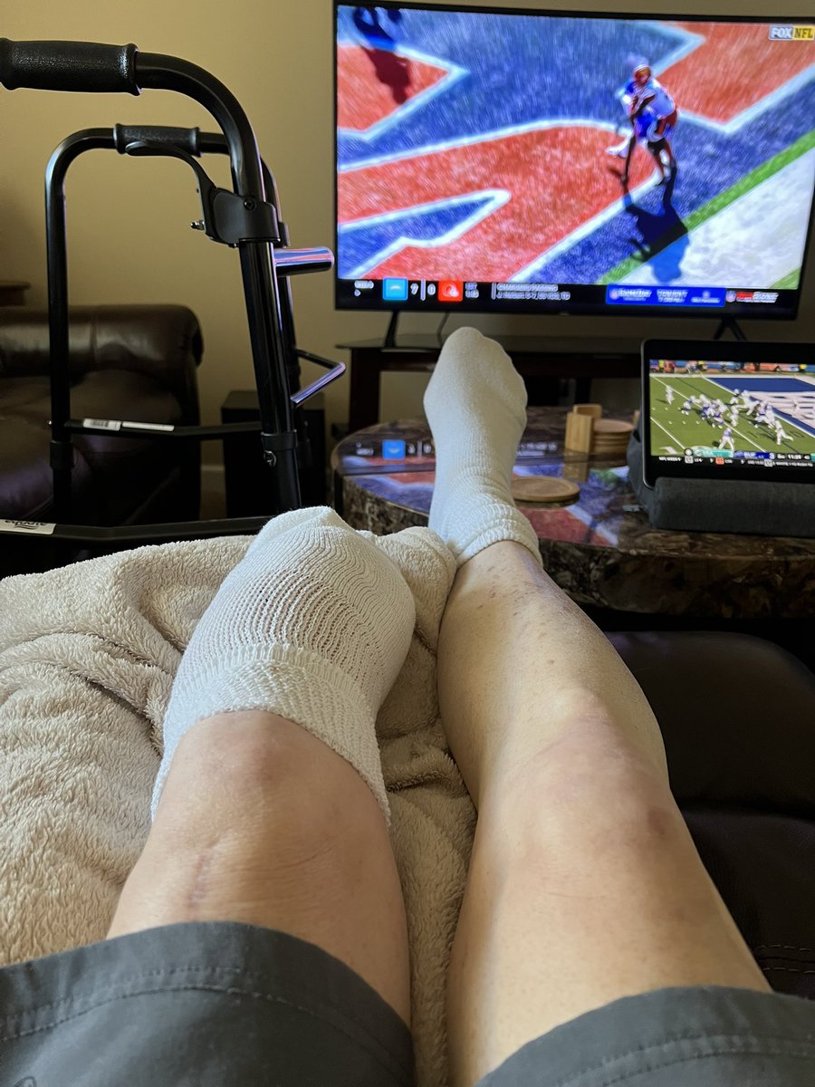 The stump… please don’t be grossed out. No pain today at all. And I got a shower today with tub transfer bench. Was just washing up daily before for 3 weeks. Nothing beats a shower. I got a sock on it. Stump socks ordered. . <a href="/jimkenn06603124/">jim</a> <a href="/RRKetcham4/">Rick</a> I know Jimi loves this 😂