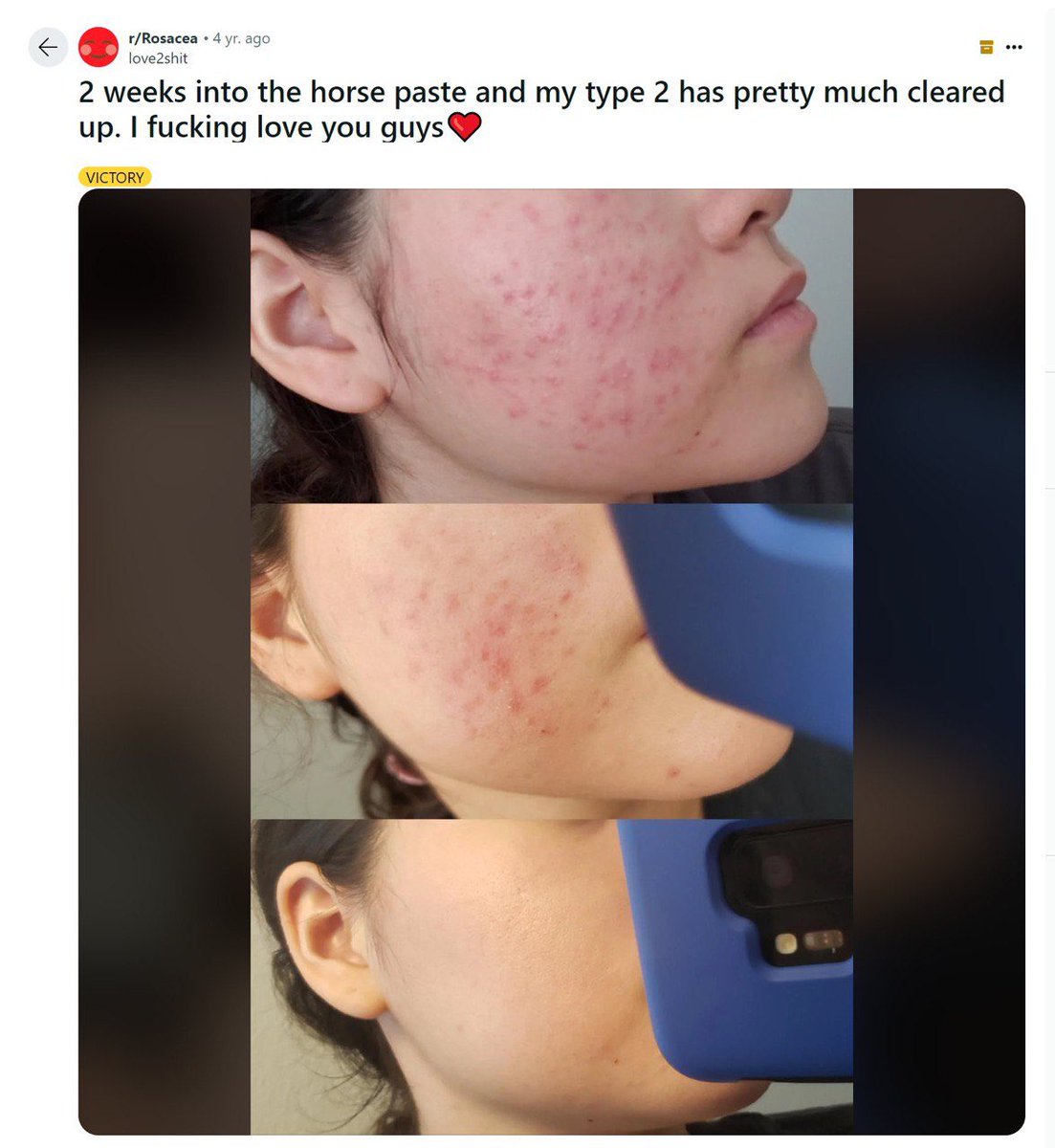 Another example of what ivermectin “horse paste” can do topically. 8.99 a tube on Amazon. 🤷🏻‍♀️