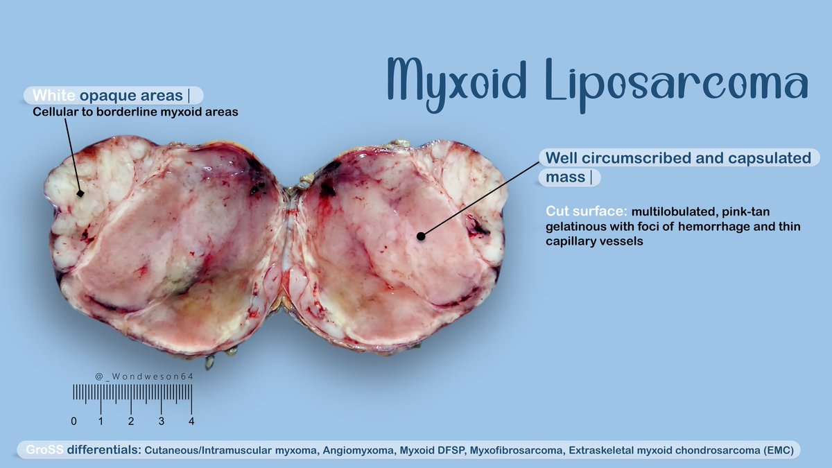 _Wondweson64's tweet photo. 🔬Diagnosis &amp; Annotated Pearls | Previous Case!
➤ MYXOID LIPOSARCOMA, Thigh
#Pathresidents #PathTwitter #BSTpath @Pathologists #pathX #path2path @Pathoutlines @AceMyPath https://t.co/zPv3ztEmiy