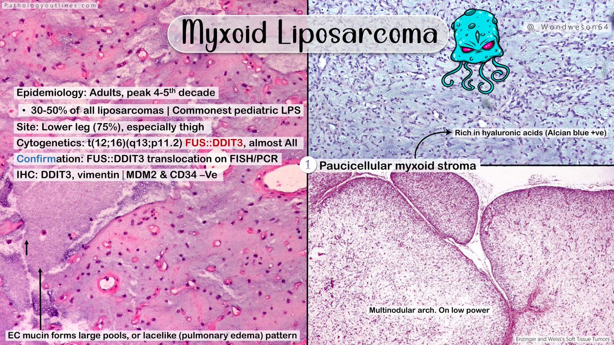 _Wondweson64's tweet photo. 🔬Diagnosis &amp; Annotated Pearls | Previous Case!
➤ MYXOID LIPOSARCOMA, Thigh
#Pathresidents #PathTwitter #BSTpath @Pathologists #pathX #path2path @Pathoutlines @AceMyPath https://t.co/zPv3ztEmiy