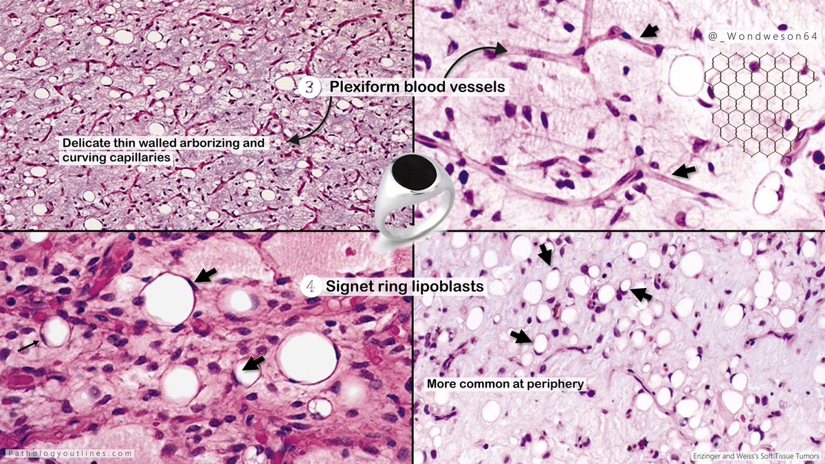 Wondweson64 Alemu (@_wondweson64) on Twitter photo 🔬Diagnosis & Annotated Pearls | Previous Case!
➤ MYXOID LIPOSARCOMA, Thigh
#Pathresidents #PathTwitter #BSTpath <a href="/Pathologists/">CAPathologists</a> #pathX #path2path <a href="/Pathoutlines/">PathologyOutlines.com</a> <a href="/AceMyPath/">Ace My Path</a> 🔬Diagnosis & Annotated Pearls | Previous Case!
➤ MYXOID LIPOSARCOMA, Thigh
#Pathresidents #PathTwitter #BSTpath <a href="/Pathologists/">CAPathologists</a> #pathX #path2path <a href="/Pathoutlines/">PathologyOutlines.com</a> <a href="/AceMyPath/">Ace My Path</a>