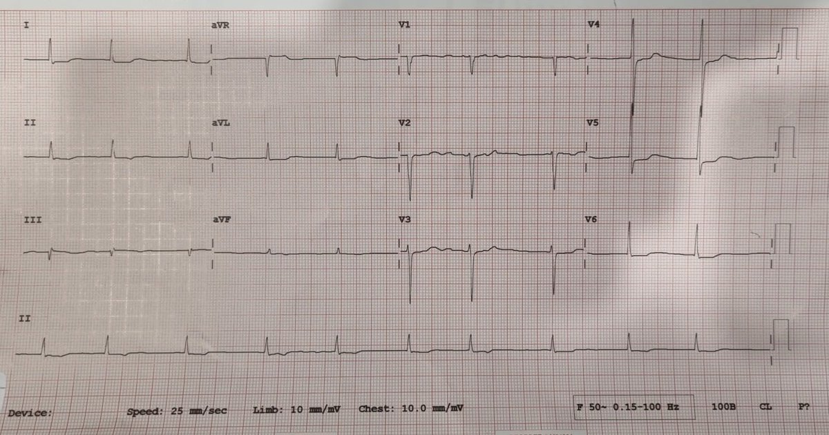 ST4_Cardiology's tweet photo. A 76-year-old man is found to have bradycardia during preoperative assessment for right hip replacement. He has no cardiac symptoms. 
How would you manage the patient given his clinical history and ECG findings?

Subscribe now to https://t.co/qex694rrpk https://t.co/Po1BroinTn