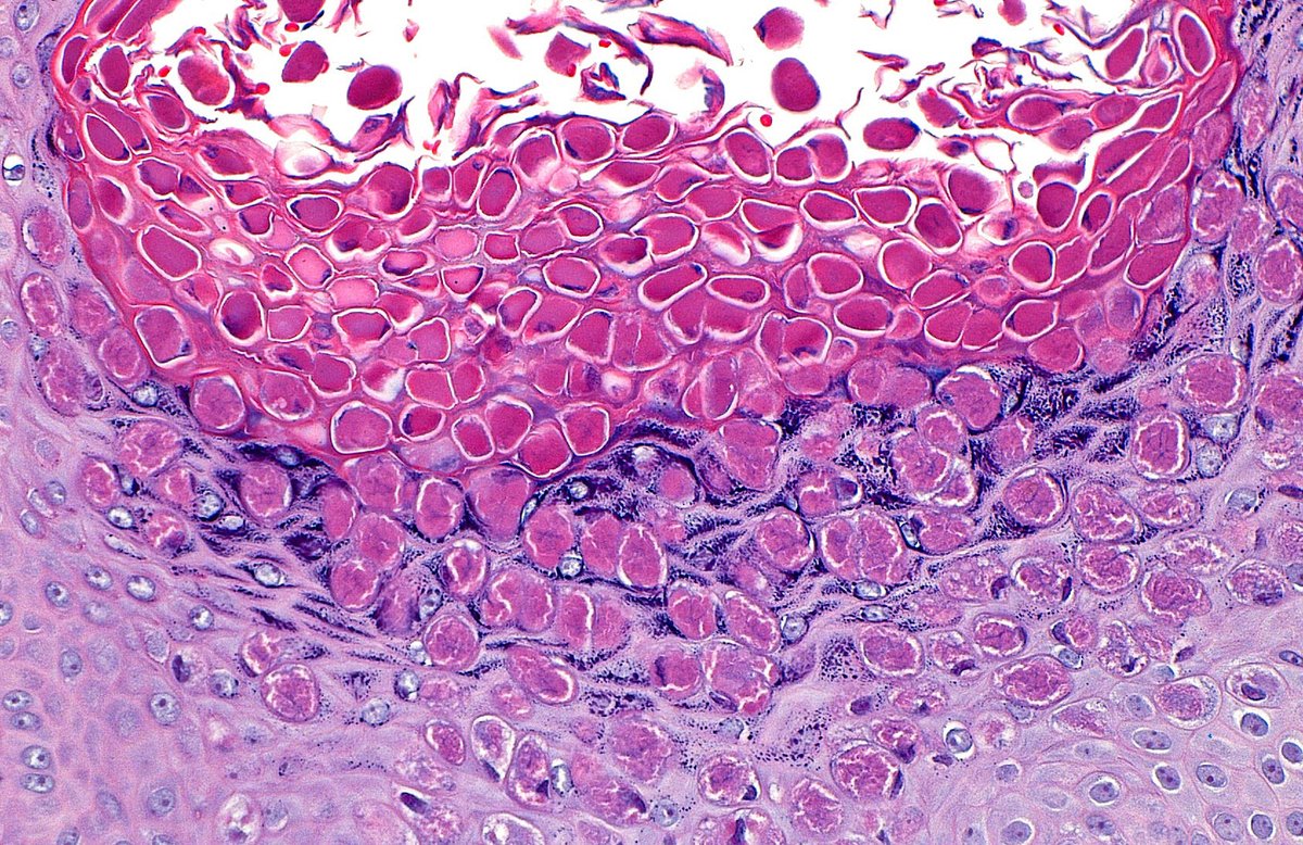 🔬 Molluscum Contagiosum ~ #Dermpath #Dermatology #Histology #Pathology