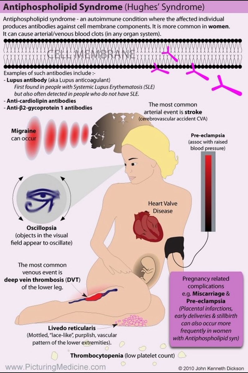 JasmineNephro's tweet photo. 🎯Antiphospholipid Syndrome https://t.co/WPAQNYqm3M