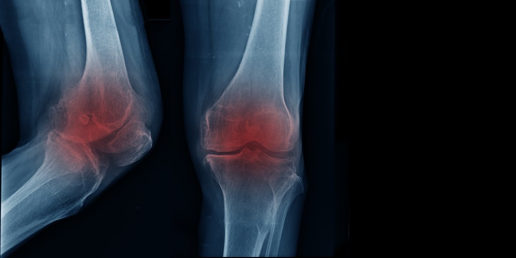 Osteoarthritis Knee - Current Evidence for Assessment and Management

(14 Nov 12.30-13.15)

An update for clinicians on the current evidence for assessing and managing patients who present with OA of the knee in #PrimaryCare

Register for FREE at &gt; bit.ly/3zpMeSe