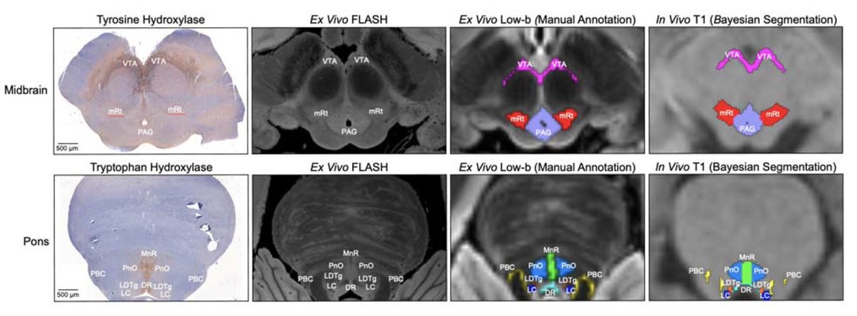 thmonk_pf's tweet image. 脳幹覚醒核研究のために750μmの等方性解像度で5つの生体外ヒト脳標本の拡散MRIを基に、上行性網様体賦活系(AAN)核の高精度なprobablistic atlasとBaise推定に基づく自動segmentation toolを開発

FreeSurferに実装予定とのこと

#soft 
#pons 
#papers 
doi.org/10.1101/2024.0…