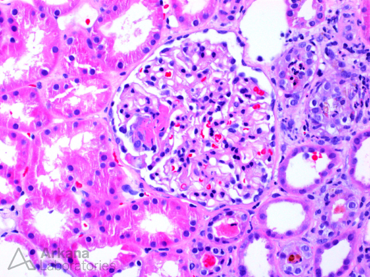 arkanalabs's tweet image. What is your presumed diagnosis in the absence of immunofluorescence and electron microscopy?

#DiagnoseThis #renalpath #nephropath