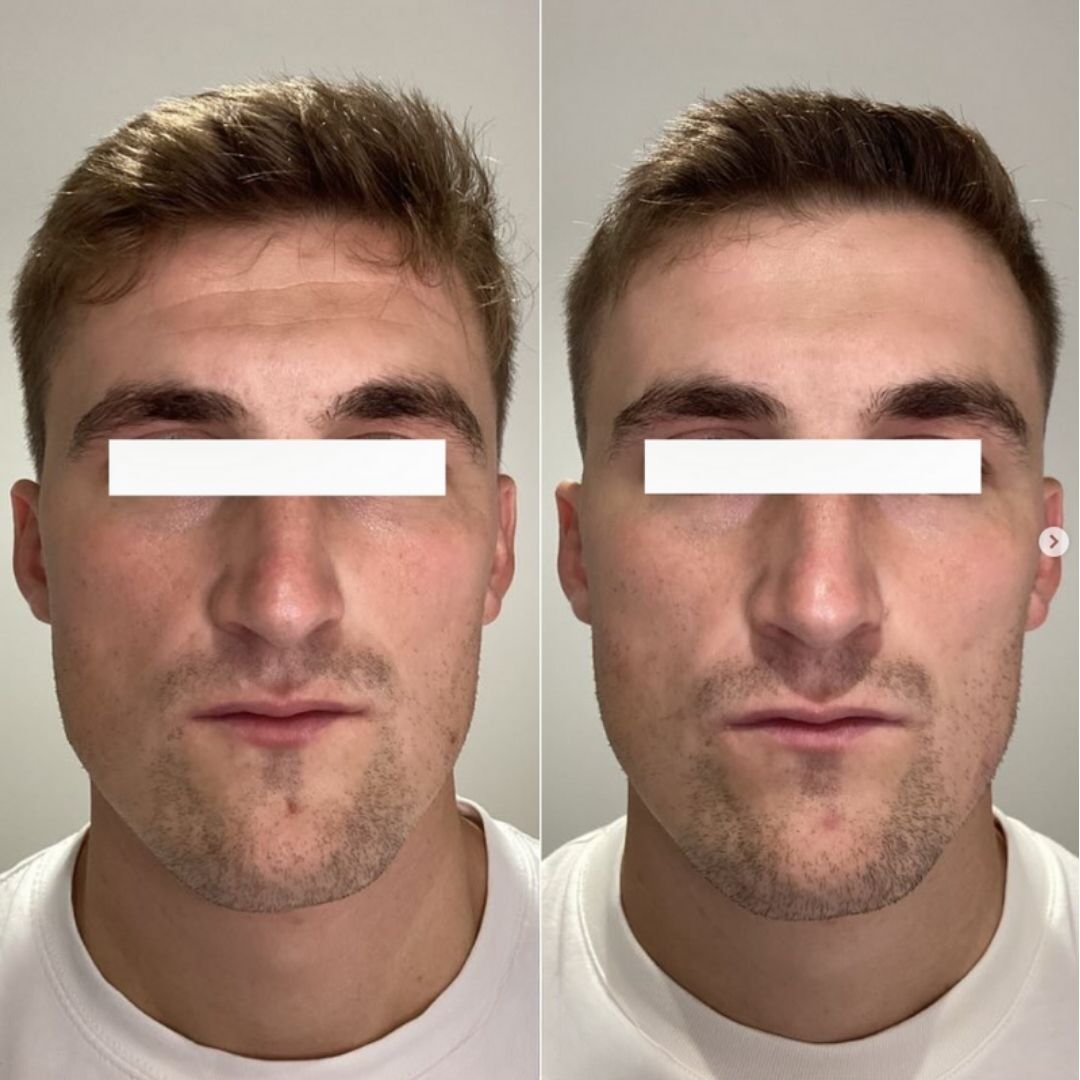 Men’s Health Month Transformation!

Targeted injectables softened lines, improved texture, and boosted his confidence—all with a natural look.

Men’s self-care matters too! Interested? DM us to learn more.

#MensHealth #BeforeAndAfter #Injectables #SkinRejuvenation