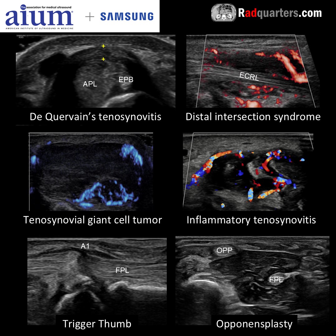 Daniel Kowal, MD, RMSK | Radquarters (@radquarters) on Twitter photo Join me for “Thumbs Up: Musculoskeletal Ultrasound of the Thumb,” a FREE webinar THIS Wed 11/6/2024 at 1 PM EST hosted by the AIUM in conjunction w/ Samsung. Register here: bit.ly/4hkp5BB, or go to aium.org. <a href="/AIUMultrasound/">AIUM Ultrasound</a> <a href="/BostonImaging/">Boston Imaging</a> #usrad #mskrad Join me for “Thumbs Up: Musculoskeletal Ultrasound of the Thumb,” a FREE webinar THIS Wed 11/6/2024 at 1 PM EST hosted by the AIUM in conjunction w/ Samsung. Register here: bit.ly/4hkp5BB, or go to aium.org. <a href="/AIUMultrasound/">AIUM Ultrasound</a> <a href="/BostonImaging/">Boston Imaging</a> #usrad #mskrad