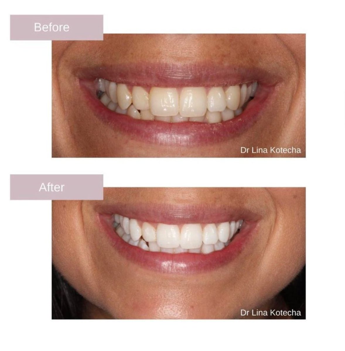 😁 Teeth whitening remains one of our favourite treatments to complete. It's a relatively simple process to complete considering the great result you get. 

Learn more: glendental.co.uk/cosmetic-denti… #teethwhitening #teethwhiteningleicester