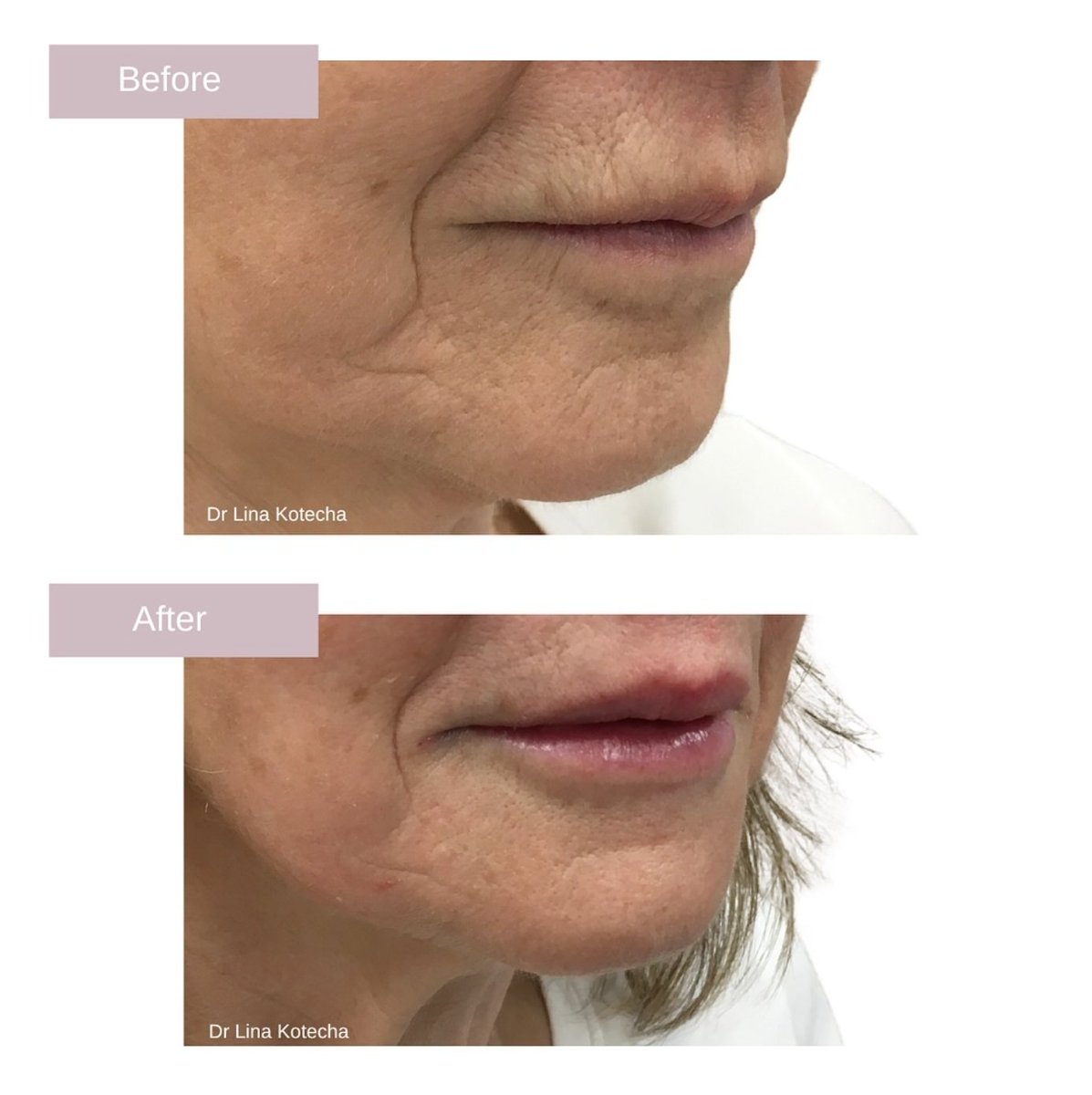Wow results!!! 😘 This is the good side of facial aesthetics! Giving women back what time can fade.

Did you know that your lips thin and age? #LipfillerLeicester can be so subtle that you notice but nobody else does.

Book a consultation with us: glendental.co.uk/facial-aesthet…