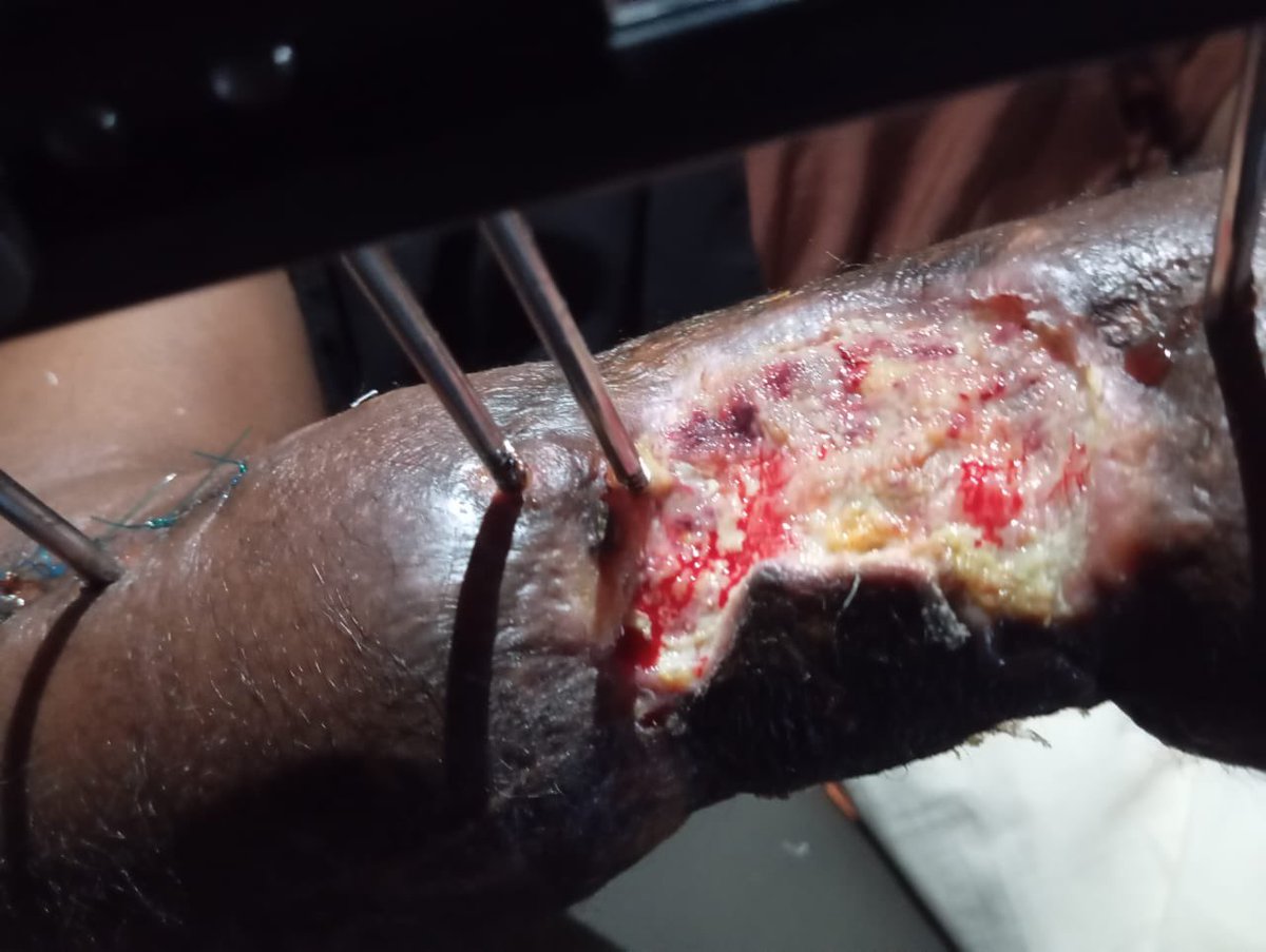 tytylaryour1's tweet photo. Ibraheem Rasheedah urgently needs financial support to complete a series of surgeries on her right arm, where she has suffered extensive bone and tissue loss.
Total Required: ₦2,500,000
Any contribution would be deeply appreciated, Thank you.
0009270910
Jaiz bank
Adedokun Mutiu https://t.co/ONkt4Ub94h