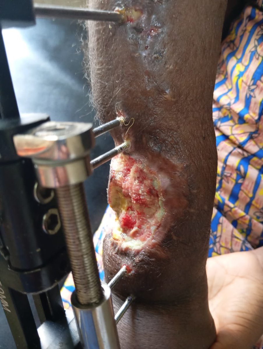 tytylaryour1's tweet photo. Ibraheem Rasheedah urgently needs financial support to complete a series of surgeries on her right arm, where she has suffered extensive bone and tissue loss.
Total Required: ₦2,500,000
Any contribution would be deeply appreciated, Thank you.
0009270910
Jaiz bank
Adedokun Mutiu https://t.co/ONkt4Ub94h