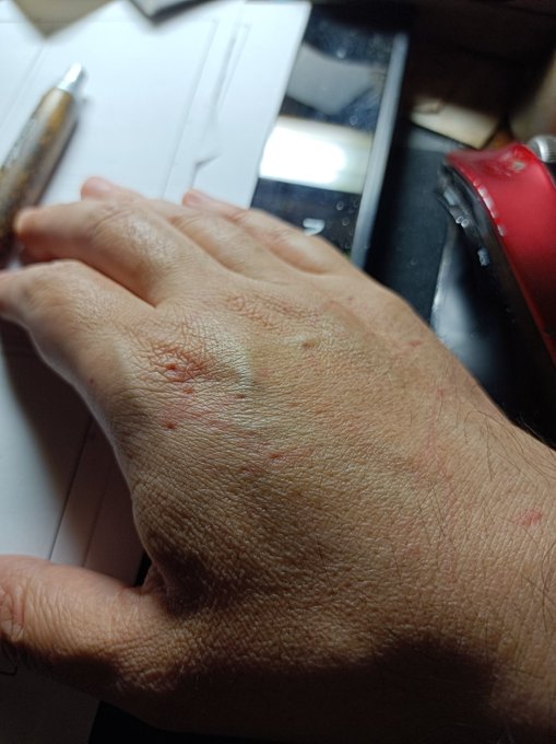 飼い猫に手を噛まれた跡 