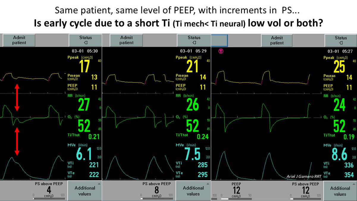 ArielG_RRT's tweet photo. What would you recommend to improve the interaction? Longer Ti vs More assistance (higher PS)? @DocMusician @emireles_c @CCF_PCCM @MegriMohammed @_MSAMEED @critconcepts @IM_Crit_ @OfVentilation @ATC_Ventilator @Vent_Busters @SaudiRTs @ventilacionmeca https://t.co/2S92WAOhvD