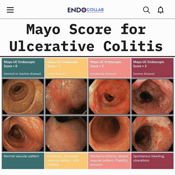 Mayo Score for Ulcerative Colitis