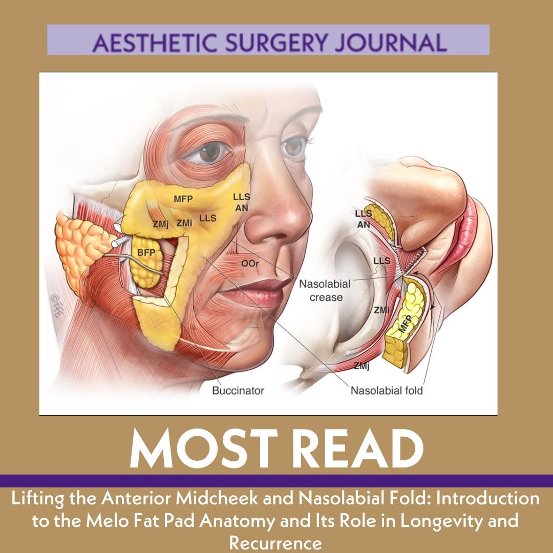 This study was done to examine the regional anatomy of the anterior midcheek and NLF, with a focus on explaining the early recurrence phenomenon, and to explore the possibility of alternative surgical methods that prolong NLF correction.

🔗Read the paper: doi.org/10.1093/asj/sj…