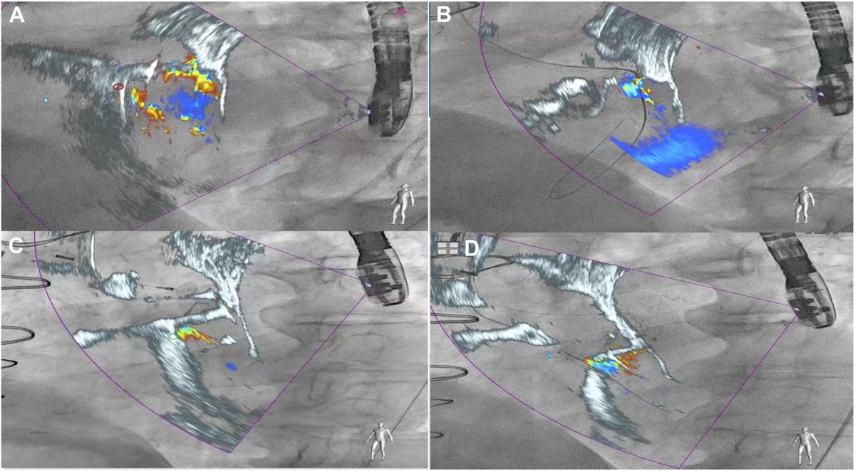 MyJSCAI (@myjscai) on Twitter photo 🚨Case report: pt w severe anterior & posterior paravalvular aortic leaks💡integration of #EchoNavigator system can enhance device positioning, safety, & outcomes in complex #structural intvns #PVL
➡️doi.org/10.1016/j.jsca…
<a href="/MustafaAhmedMD/">Mustafa Ahmed</a> <a href="/MadhuraMyla/">Madhura (Maddie) Myla, MD, FACC</a> <a href="/DocEBROhimi/">Ali Ebrahimi</a> <a href="/Salama_AmrA/">Amr Salama</a> 🚨Case report: pt w severe anterior & posterior paravalvular aortic leaks💡integration of #EchoNavigator system can enhance device positioning, safety, & outcomes in complex #structural intvns #PVL
➡️doi.org/10.1016/j.jsca…
<a href="/MustafaAhmedMD/">Mustafa Ahmed</a> <a href="/MadhuraMyla/">Madhura (Maddie) Myla, MD, FACC</a> <a href="/DocEBROhimi/">Ali Ebrahimi</a> <a href="/Salama_AmrA/">Amr Salama</a>