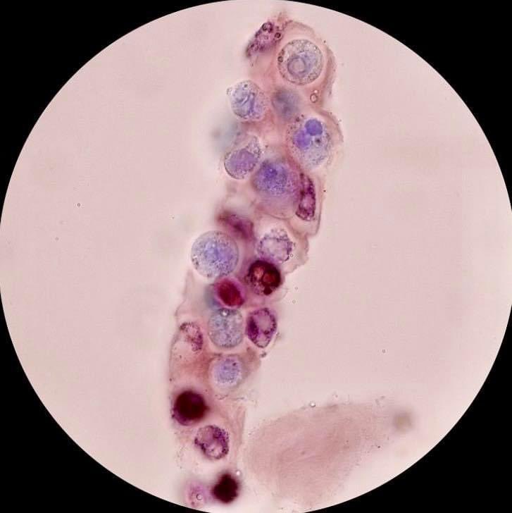 LabClinicoDG's tweet photo. Cilindro leucocitario en sedimento urinario 🔬

https://t.co/bkp89QFOnV https://t.co/U1e4YRGRp6