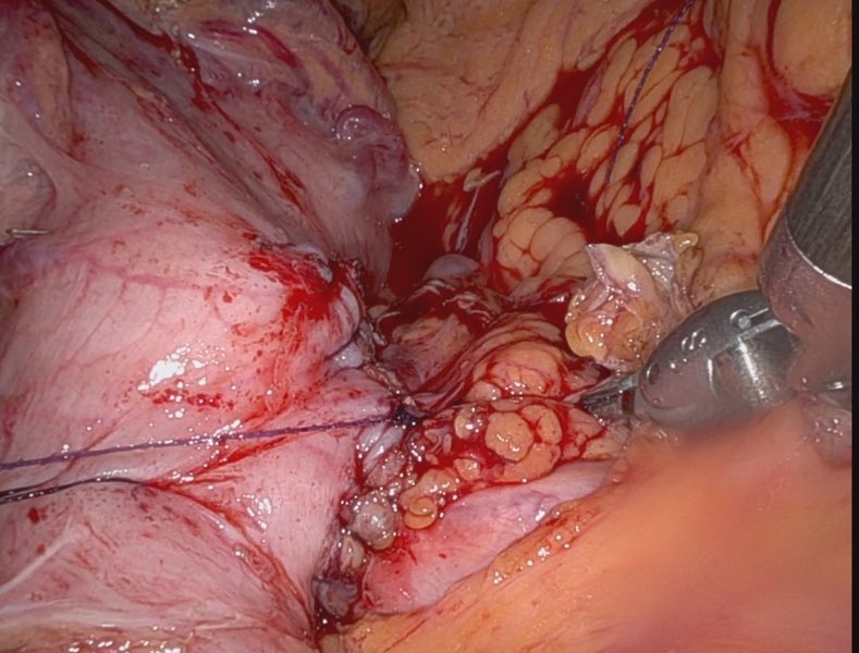 Posterior robotic approach to cystgastrostomy
 
24 111 Loe, Mallory youtu.be/bZlTFB42i9k?fe… via <a href="/YouTube/">YouTube</a>