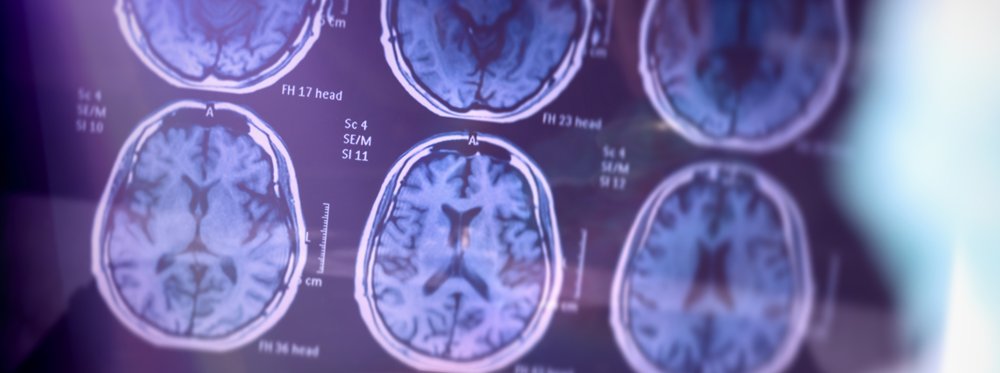 This National Alzheimer's Awareness Month is the perfect time to know what your options are when it comes to genetic testing for Alzheimer's disease, what tests can and can't tell you, &amp; who should get tested. Have questions? Leave a comment or DM us! 

🔗smithfamilyclinic.org/alzheimers-dis…