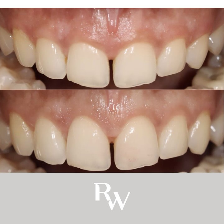 rwperio's tweet photo. BEFORE &amp; AFTER #TheCloseUp VIA THE RW PERIO RESTORATIVE 🎬
———
Did you know - a gum lift is one of the most requested aesthetic treatments here at our specialist clinic and one of the most rewarding with results visible immediately ✔️
———
DISCOVER MORE:
https://t.co/cg5UzAHLAD https://t.co/Mz69mLEyYq